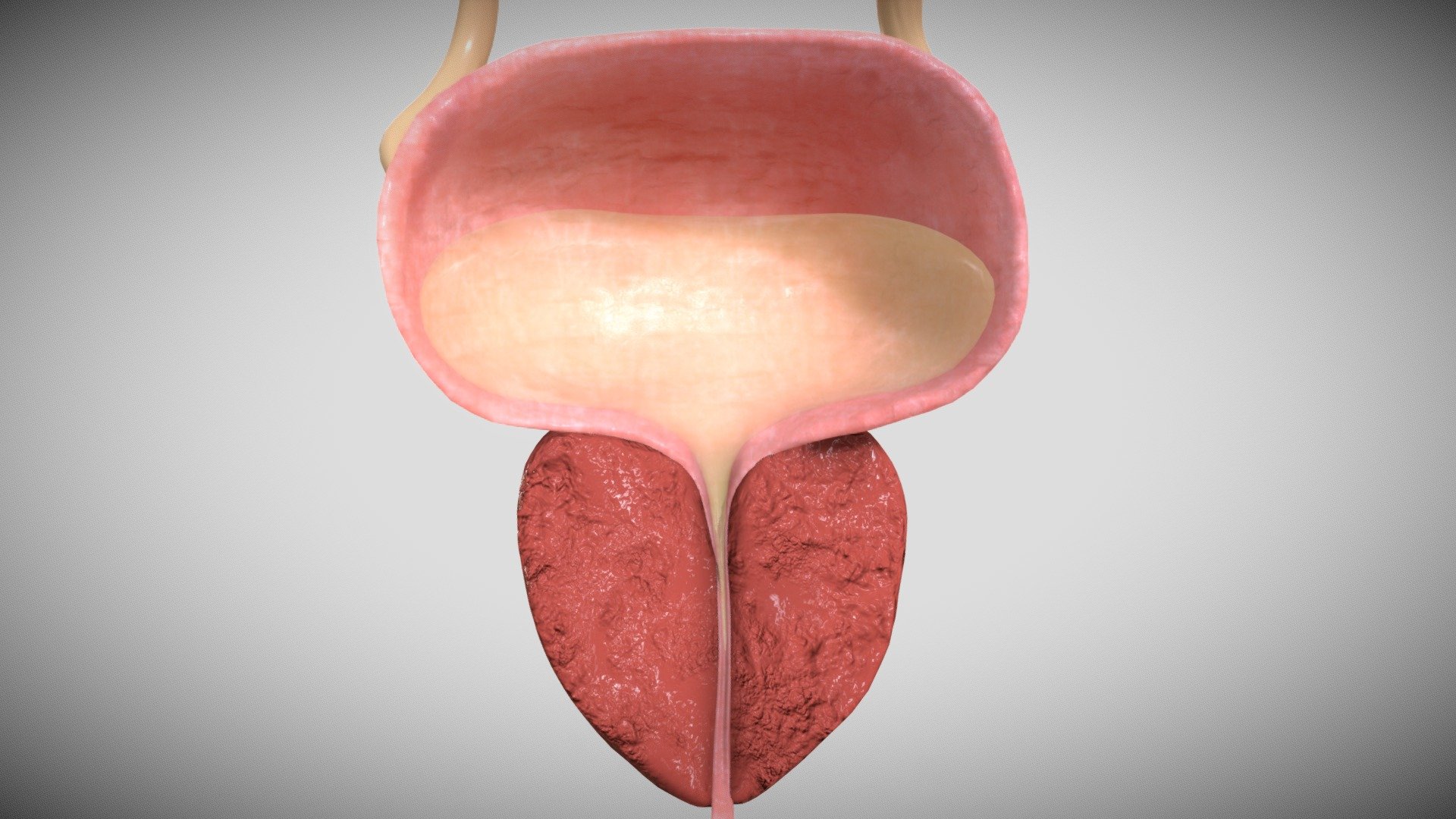 Benign prostatic hyperplasia 3d model