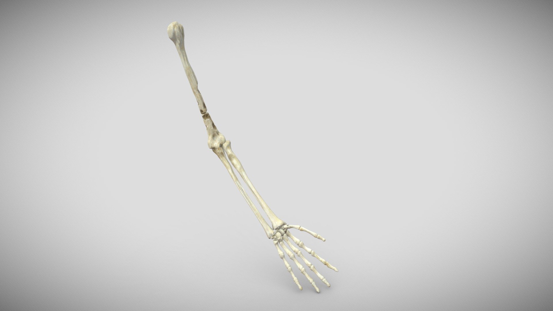 Arm with lytic lesions 3d model