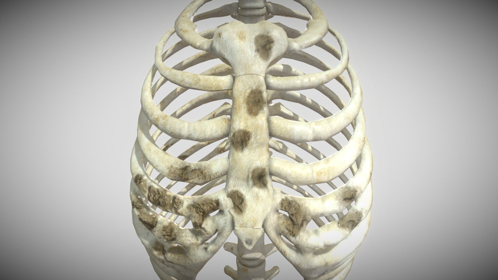 Lytic Lesions of Rib 3d model