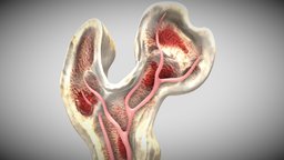 Osteolytic lesion