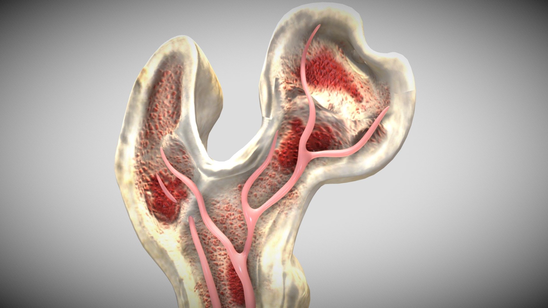 Osteolytic lesion 3d model