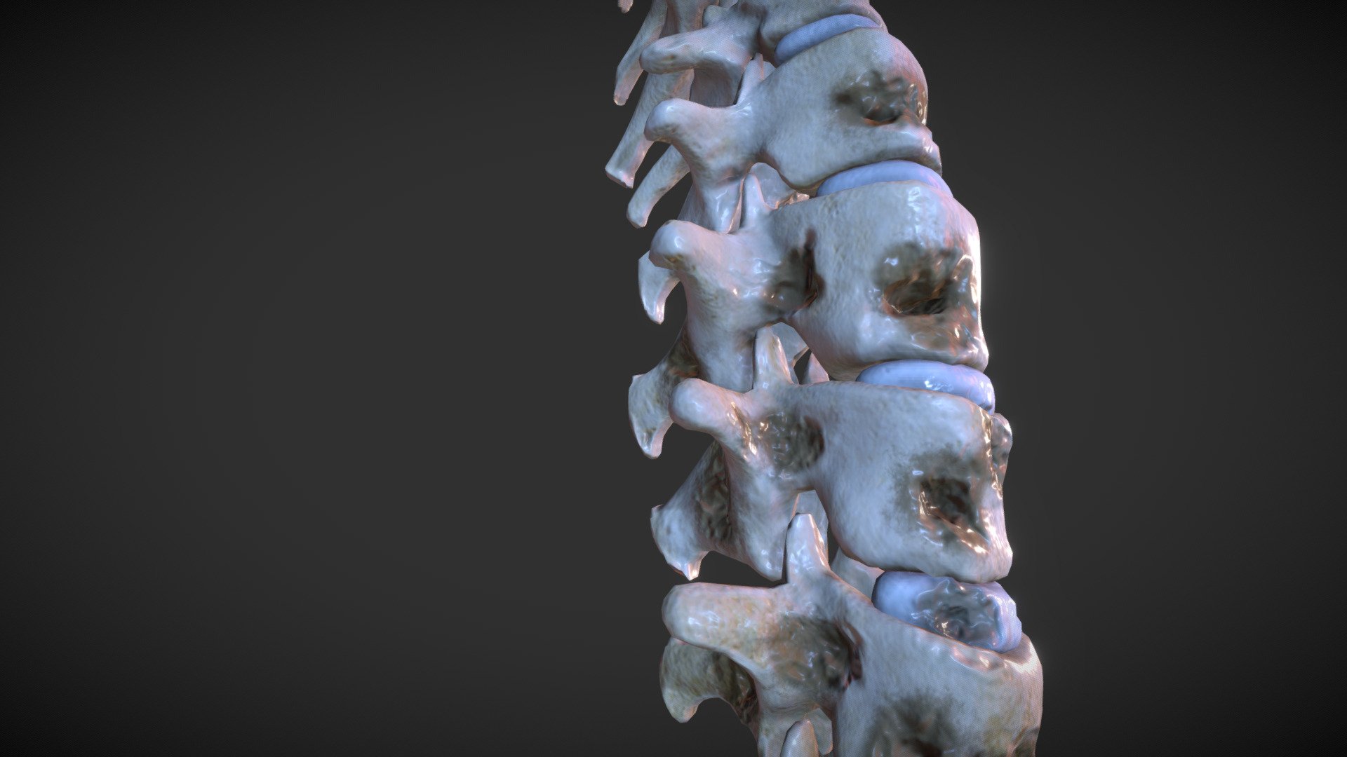 Lytic Lesions of spine 3d model