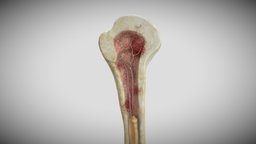 Lytic humeral lesion