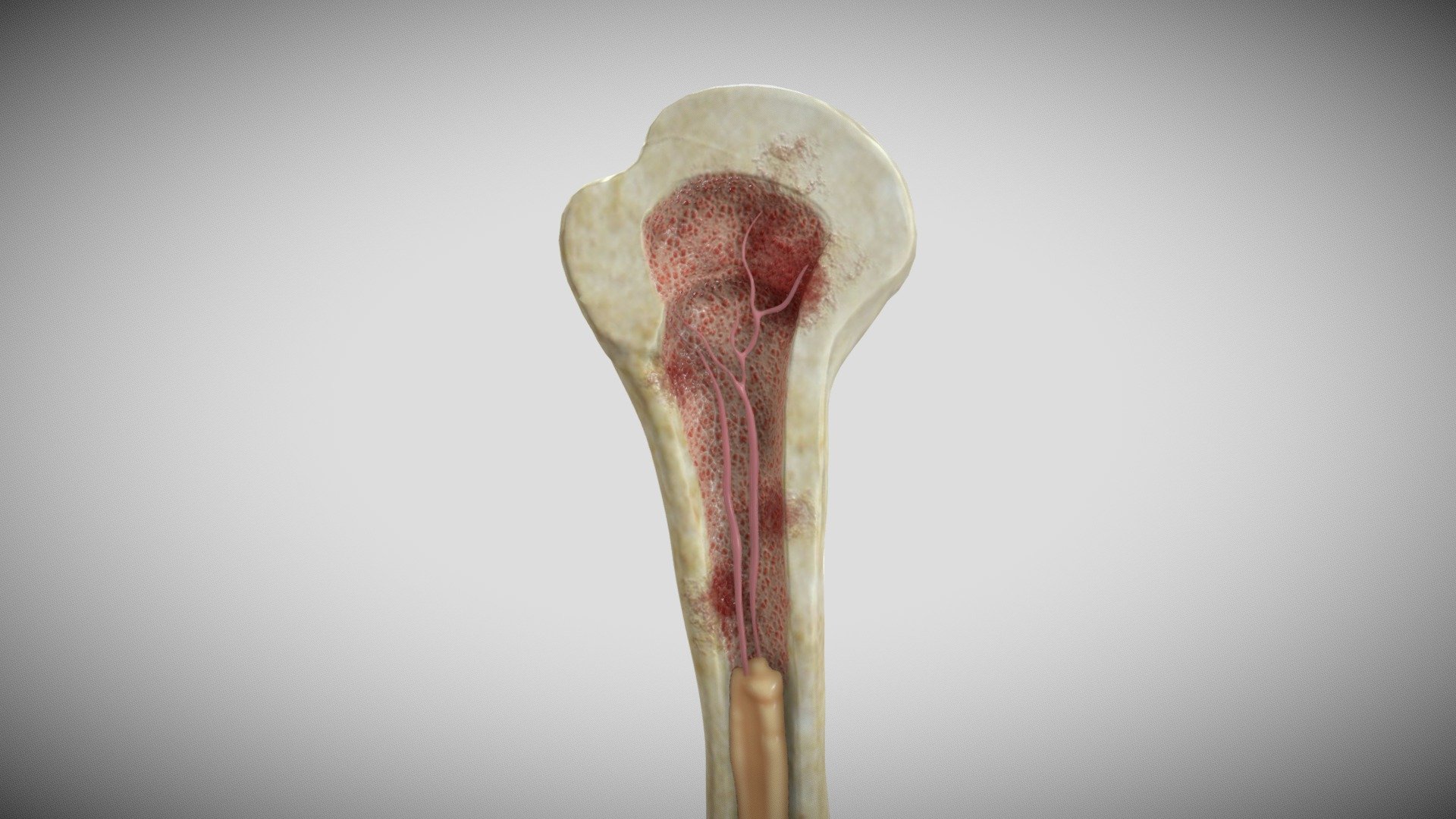 Lytic humeral lesion 3d model