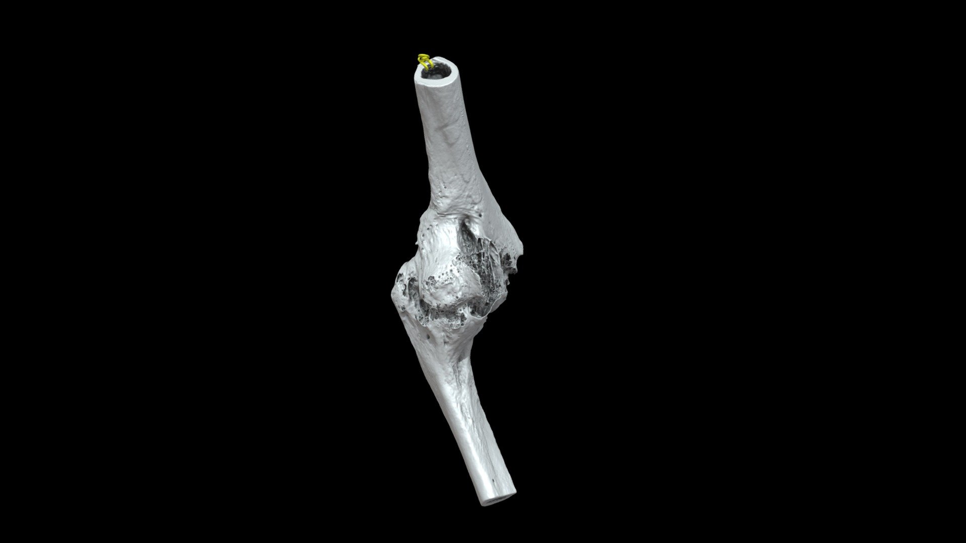 L. Elbow with Traumatic Fusion (VCU_3D_5443) 3d model