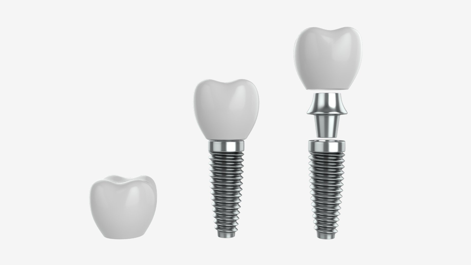 Tooth implant 3d model