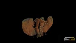 Horseshoe Kidney