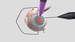 Cataract Surgery Animation