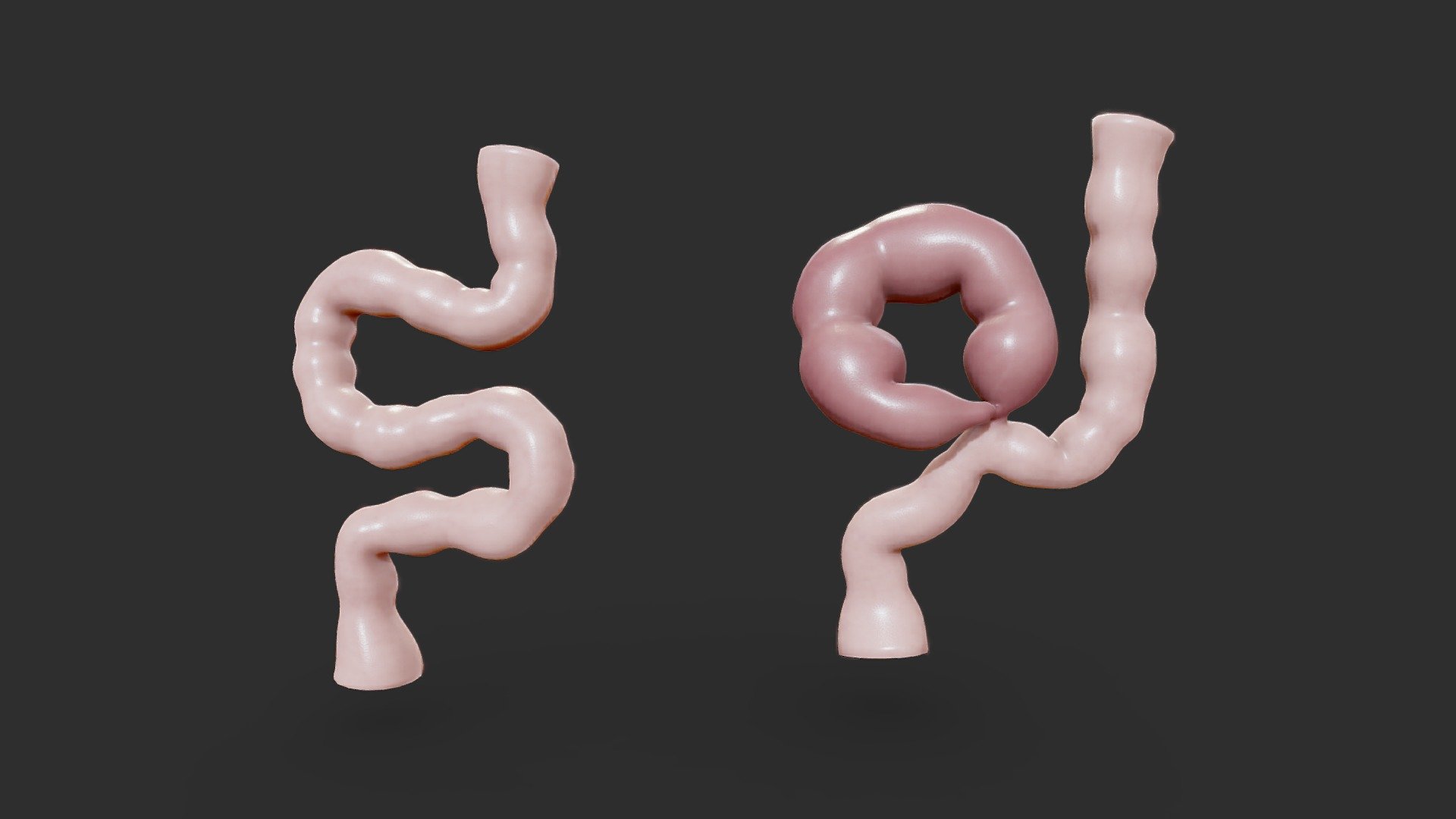 Volvulus of the Colon 3d model