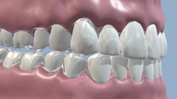 Teeth Aligners with Jaws 3D