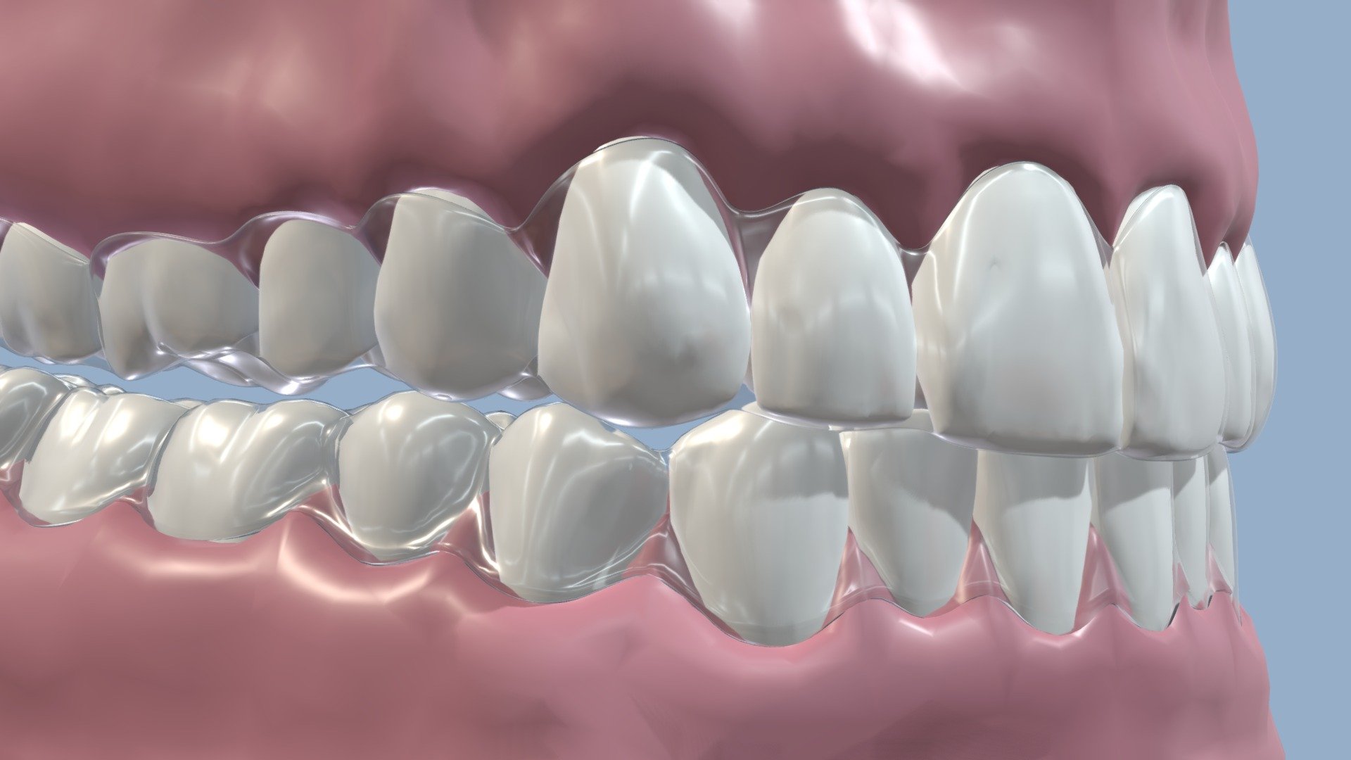 Teeth Aligners with Jaws 3D 3d model