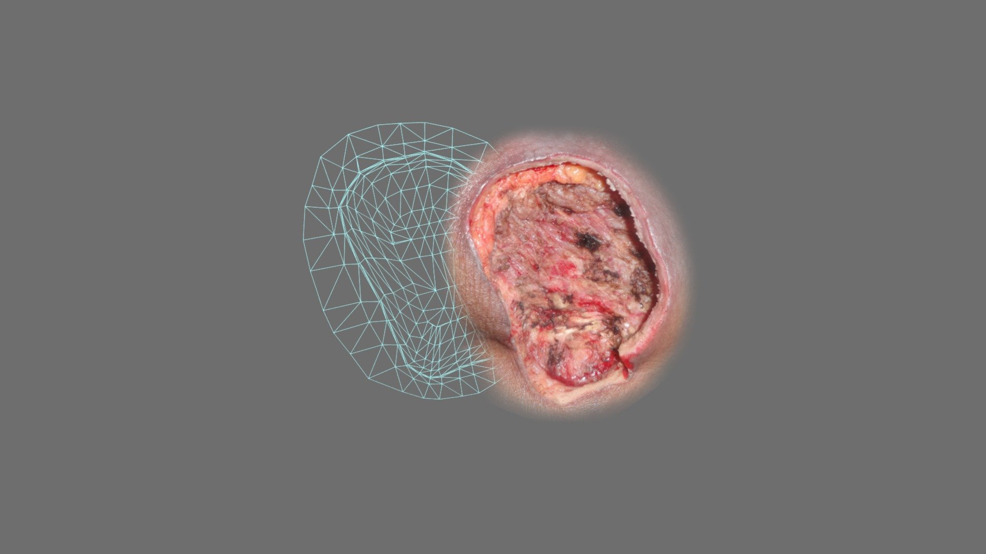 Wound 3d model