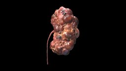 Polycystic Kidney