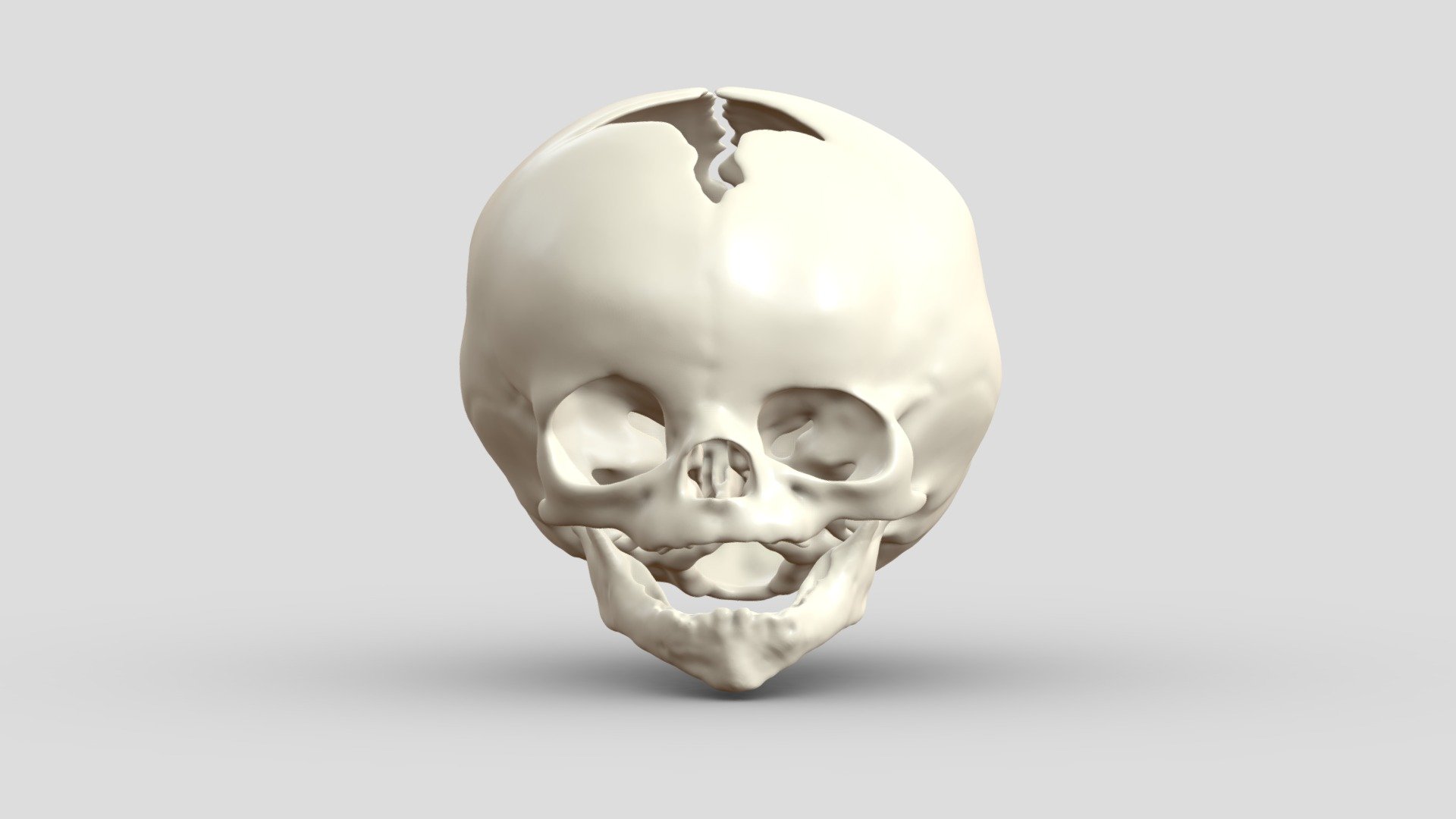 Left Frontosphenoidal Craniosynostosis 3d model