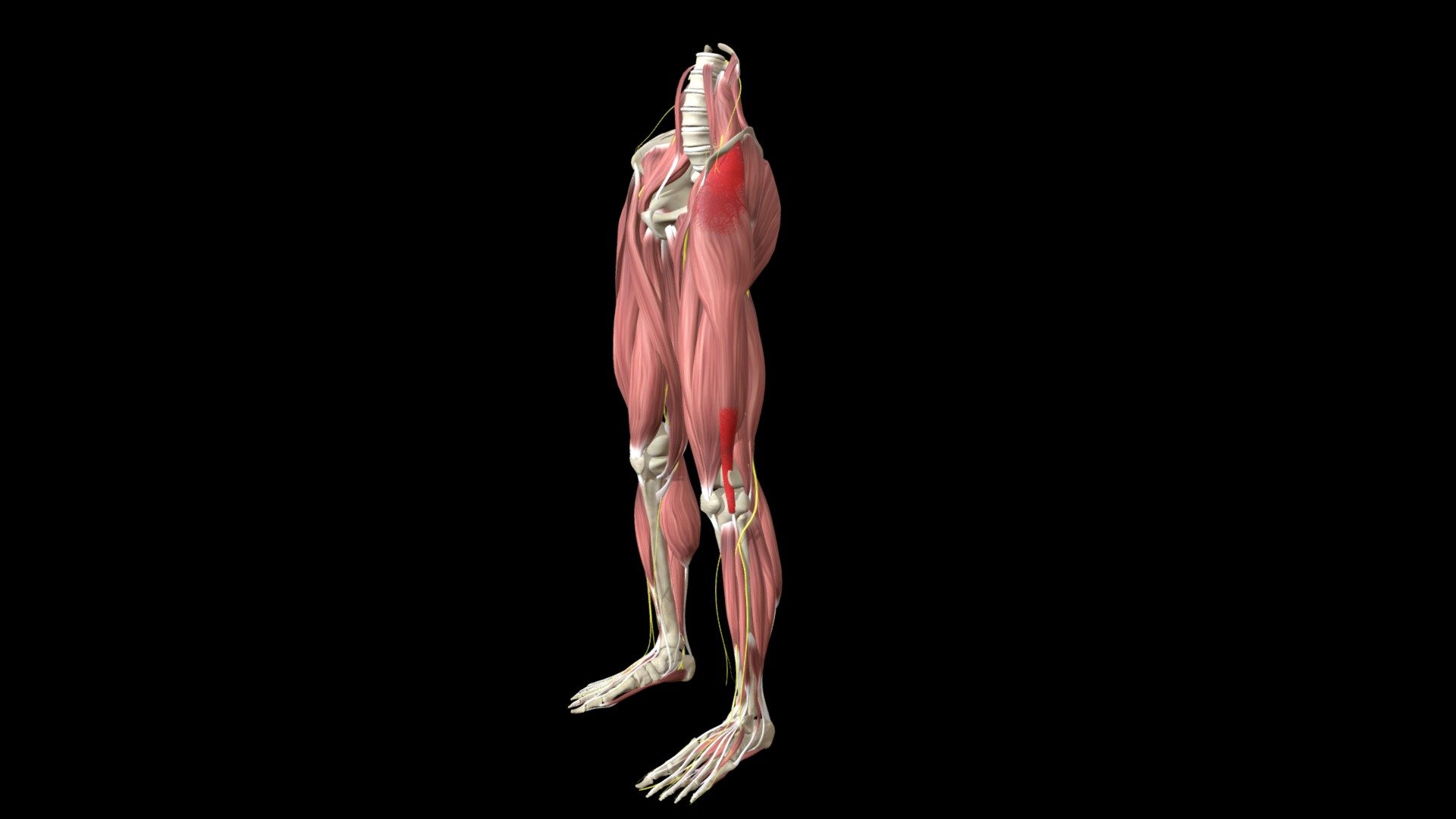 Iliotibial Band Syndrome, Tensor Fascia Latae 3d model