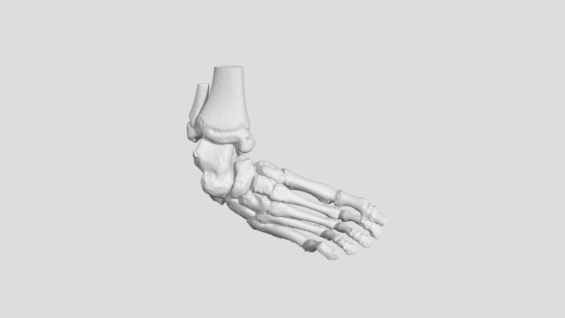 Foot Deformity (S0286) 3d model