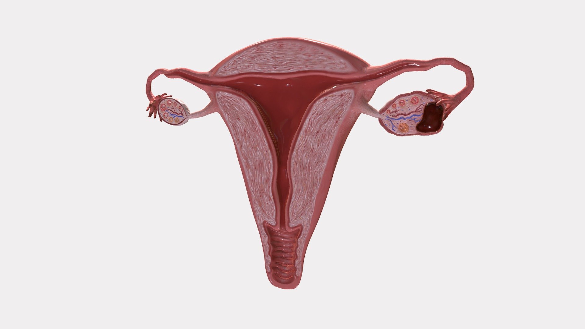 Uterus Cross Section with Endometrioma 3d model