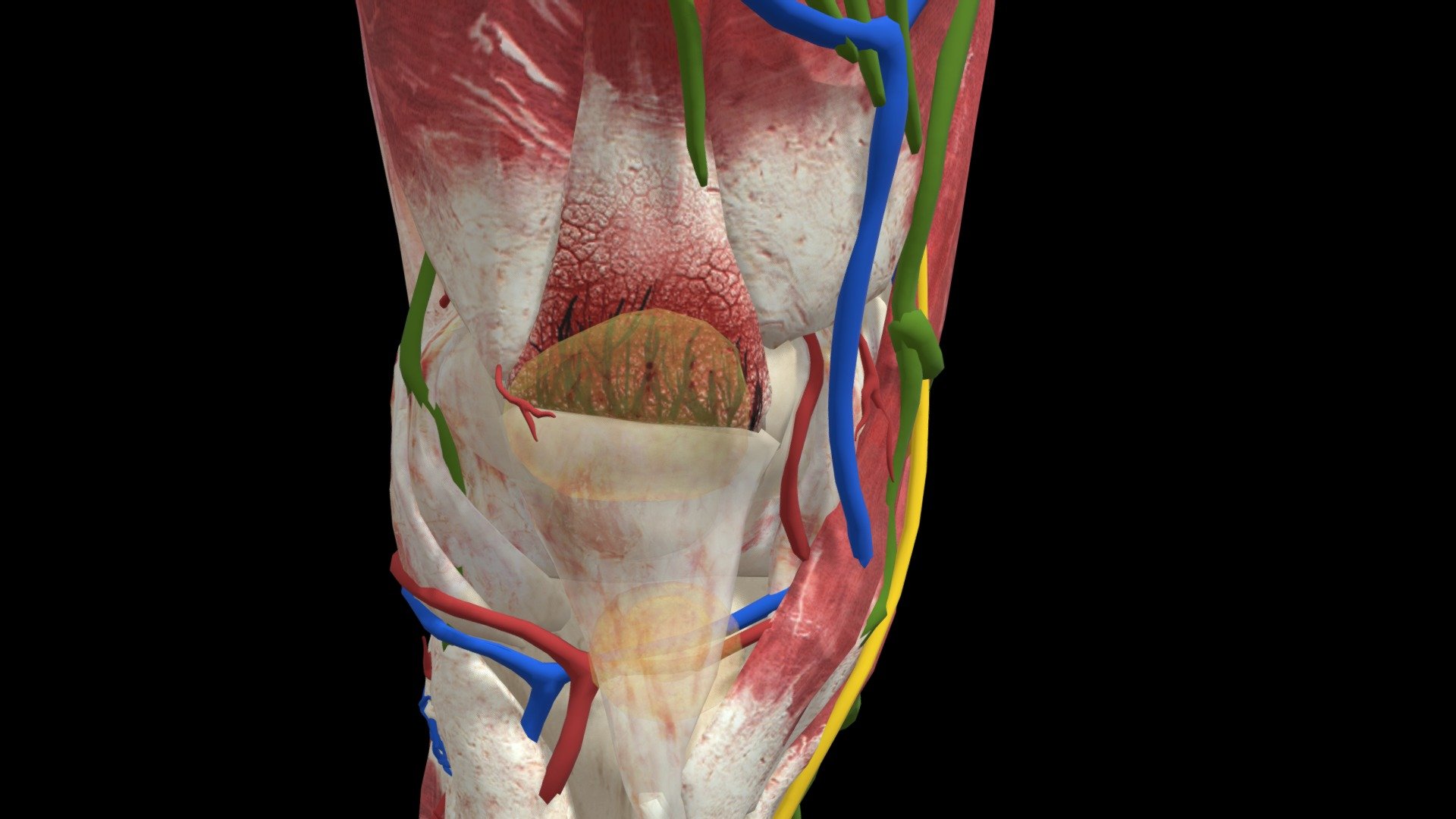 Quadracep Tendonitis 3d model